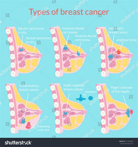 Types Breast Cancer Medical Poster Vector: vetor stock (livre de ...
