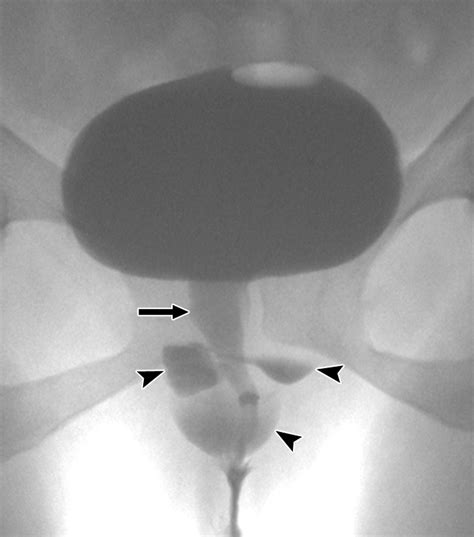 Pre- and Postoperative Evaluation of Urethral Diverticulum | AJR