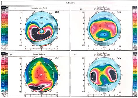 Pellucid Marginal Degeneration: A Comprehensive Review of Pathophysiology, Diagnosis, and ...