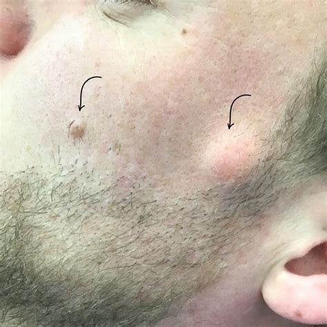 Pictures of Cysts Under the Skin | Common Types & Examples