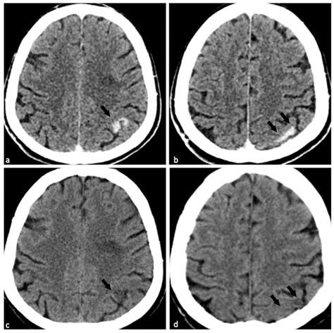 Dual-Energy Computed Tomography (DECT) for Diagnosing Contrast-Induced ...