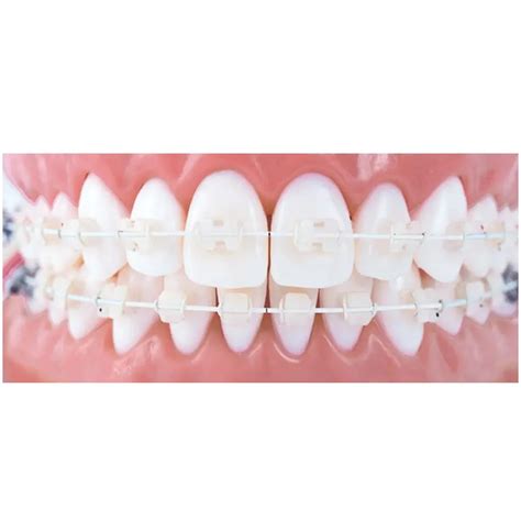 Buy JJ Ortho Tooth Colored NiTi Archwires - Round – Oralkart