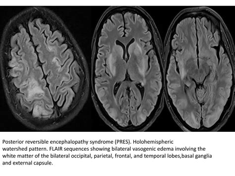 Amol toxic and metabolic encephalopathy syndrome | PPT