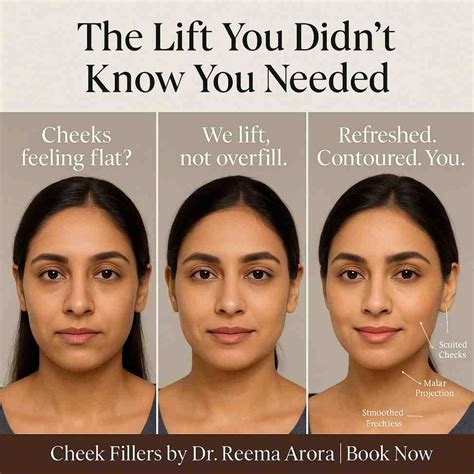 Best Cheek Fillers Cost in Delhi | Dermal Fillers India | Cheek ...