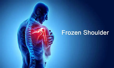 Frozen Shoulder at Orthopaedic Speciality Care in Shivajinagar, Pune