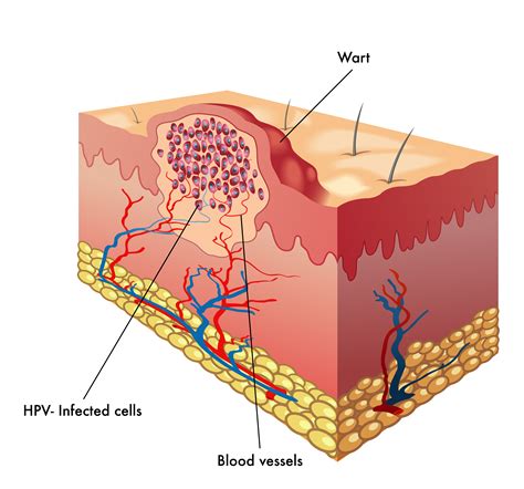 Anal Condyloma | Colon & Rectal Specialist Serving VA | Colon & Rectal Specialists, LTD