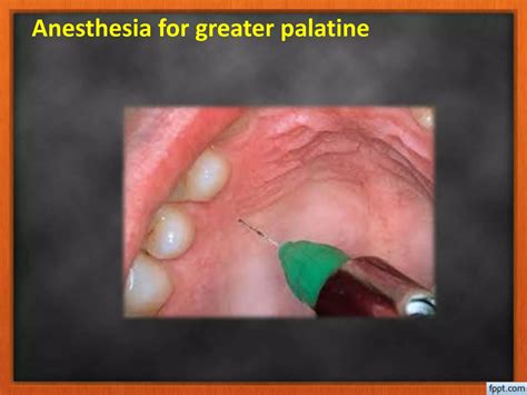 Extraoral Technique of Local Anesthesia 的图像结果