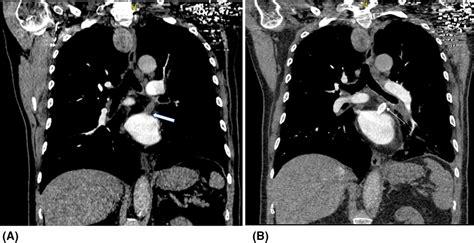 Pulmonary vein stenosis presenting as massive hemoptysis, treated with ...
