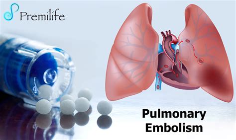 Pulmonary Embolism | Premilife - Homeopathic Remedies