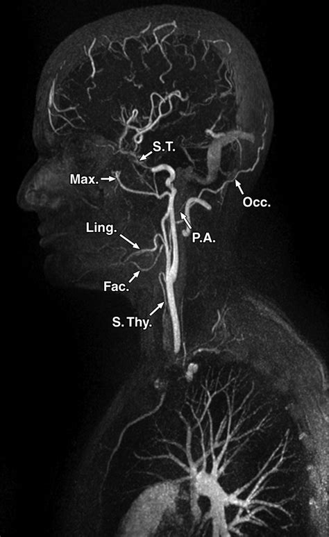MR Angiography at 3 T for Assessment of the External Carotid Artery ...
