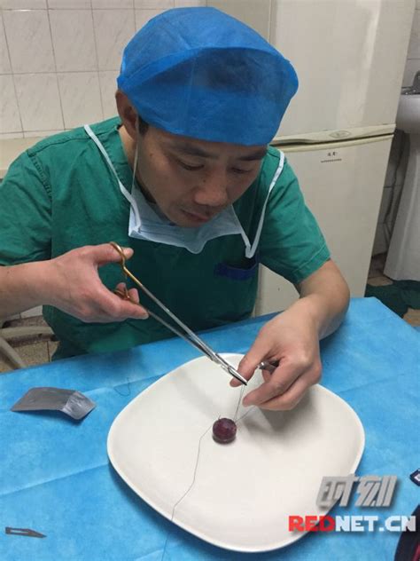为锻炼手指灵活性，湖南一外科医生用棉签吃饭、缝葡萄皮-大河新闻