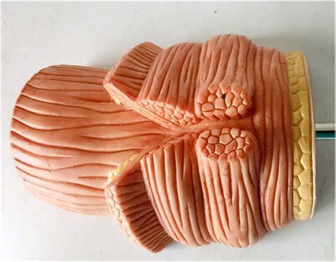 Buy Teaching model Rectal Model - Medical Teaching Internal Hemorrhoid ...