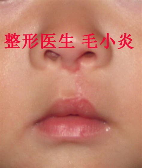 【公益宣传片】先天性唇腭裂的预防和治疗--把幸福微笑送给每个儿童！请分享……
