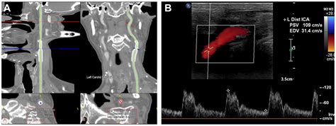 Surveillance and risk factors for early restenosis following transcarotid artery ...