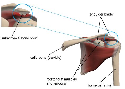 Subacromial Impingement Treatment – AFBUA