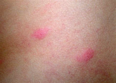 丘疹性蕁麻疹- 台灣Wiki