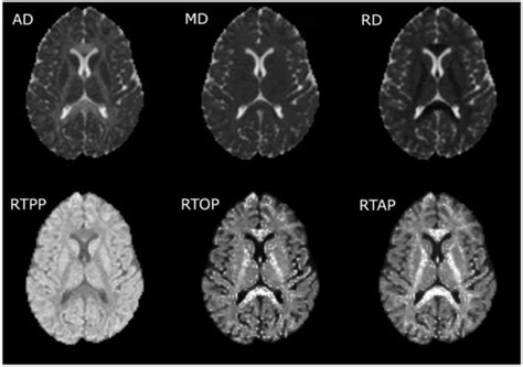 Alternative Microstructural Measures to Complement Diffusion Tensor ...