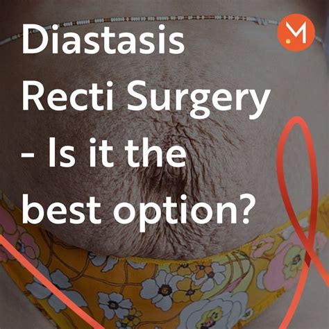Diastasis Recti Surgery - MUTU System in 2025 | Operation