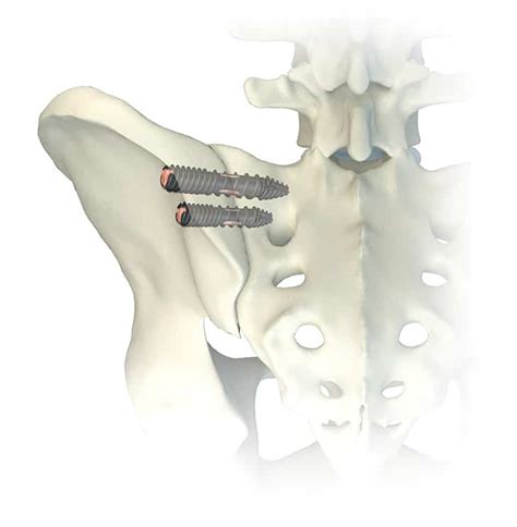Image result for Contralateral Oblique View