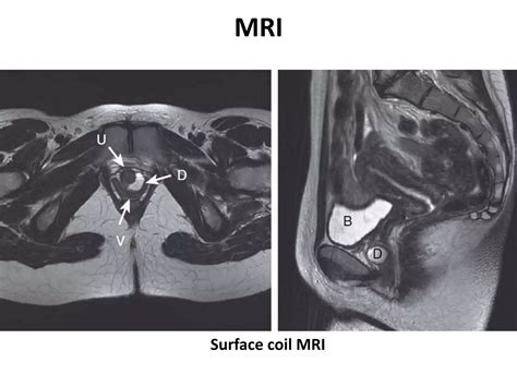 Urethral diverticulum | PPTX
