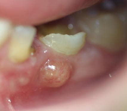 Bildergebnis für ruptured abscess in mouth