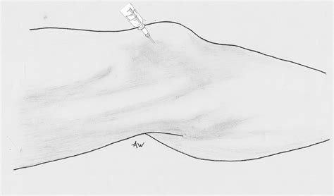 Image result for Ankle Injection Lateral Approach