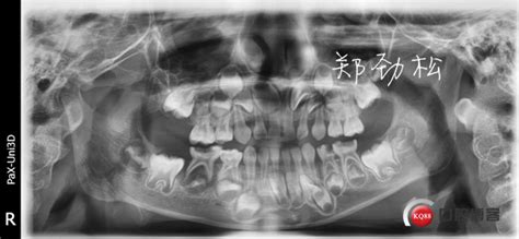 几例儿牙的根管治疗的体会-郑劲松的博客-KQ88口腔博客