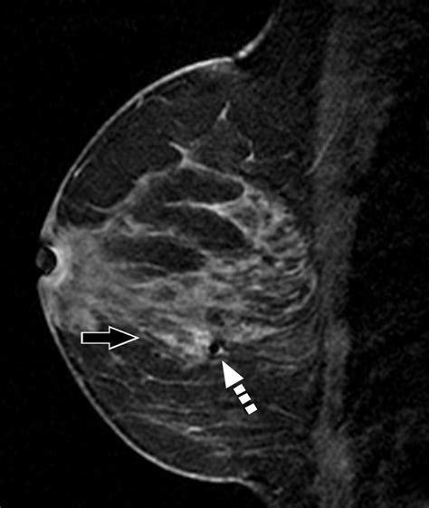 Underestimation of Atypical Ductal Hyperplasia at MRI-Guided 9-Gauge Vacuum-Assisted Breast ...