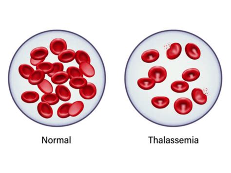 Thalassemia: Here’s all you need to know about the blood disorder | The ...