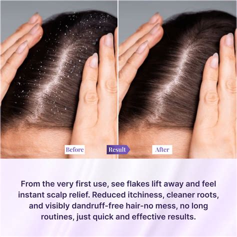 Sanfe Instant Dandruff Removal Gel | Fast Relief from Dandruff