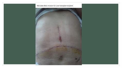 Living Donor Liver Transplant presentation .pptx