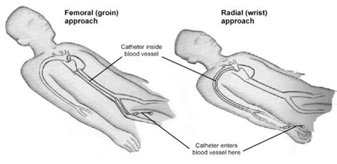 Coronary Angiogram Procedure 的图像结果