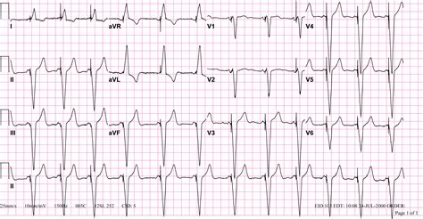 The EKG in a patient with a pacemaker - wikidoc
