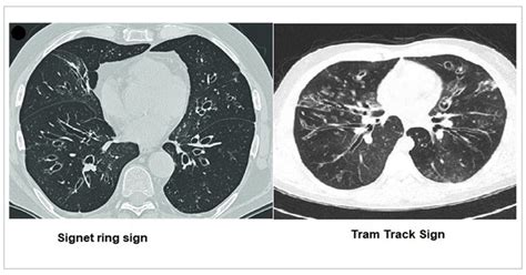 Commonly encountered chest/lung CT scan signs and their relevance