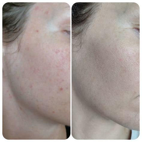 Enlarged Sebaceous Gland Treatment Treatment Of Sebaceous Hyperplasia