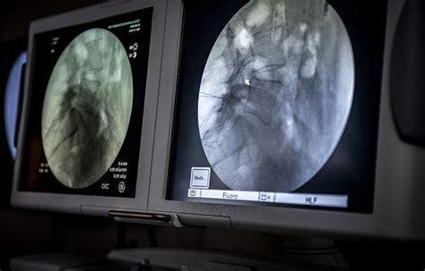 Image result for Back Arthrogram Technique