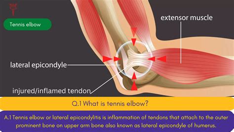 Tennis Elbow | PDF