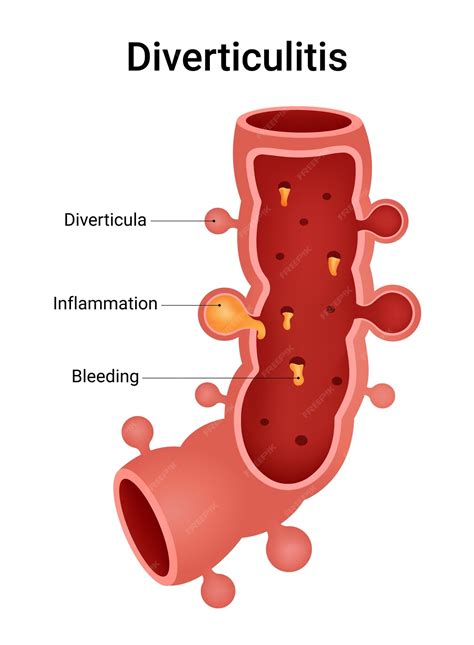 Premium Vector | Causes of the Diverticular Diseases