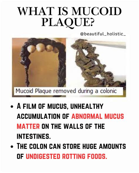 Eva A. 🌿 Nature’s Remedies | Mucoid Plaque is a formal name for the ...