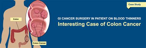 Interesting Case of Colon Cancer | A Patient Case Study of Colon Cancer ...