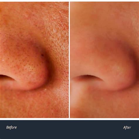 What Causes Pores To Clog at Edward Criss blog