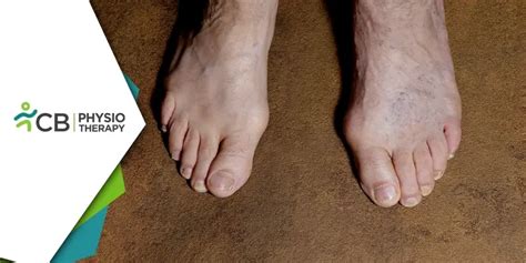 Gangrene Management | How Physiotherapy Plays a Vital Role in Recovery ...