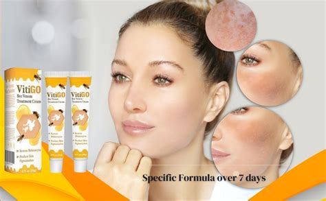 New Vitigo Bee Venom Treatment Cream For Skin and Rashes for All Skin ...