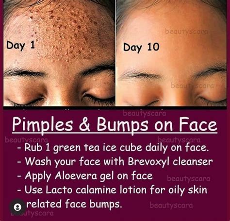 Pin by Afrikah on Skin Care/ Dental Care | How to get rid of pimples, Face skin care, Pimples on ...