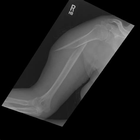 Bone Fracture Detection Using Image Processing Source Code GitHub 的图像结果