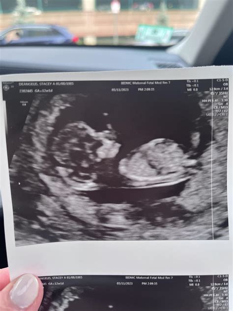 12 Week Ultrasound Boy