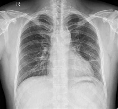 Chest Xray Masks and Labels - Dataset Ninja