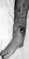 Infected Nonunion: Ankle Case 1 - Dr. Mark Brinker, Houston Orthopedic ...