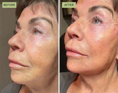 Image result for Cheek Threads