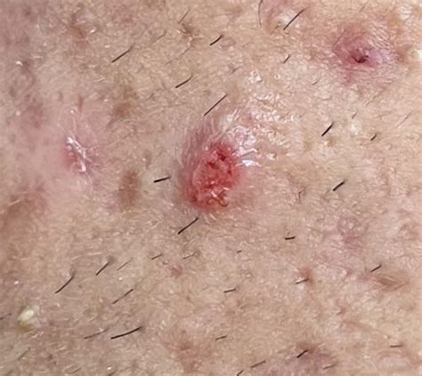 Image result for Blood Red Pimple